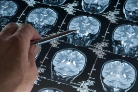 Araştırma: Alzheimer düşünüldüğünden daha erken başlay