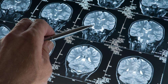 Araştırma: Alzheimer düşünüldüğünden daha erken başlay